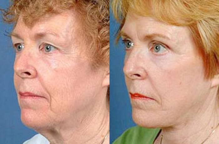 Before & After Facelift Case 69 View #2 View in Louisville & Lexington, KY