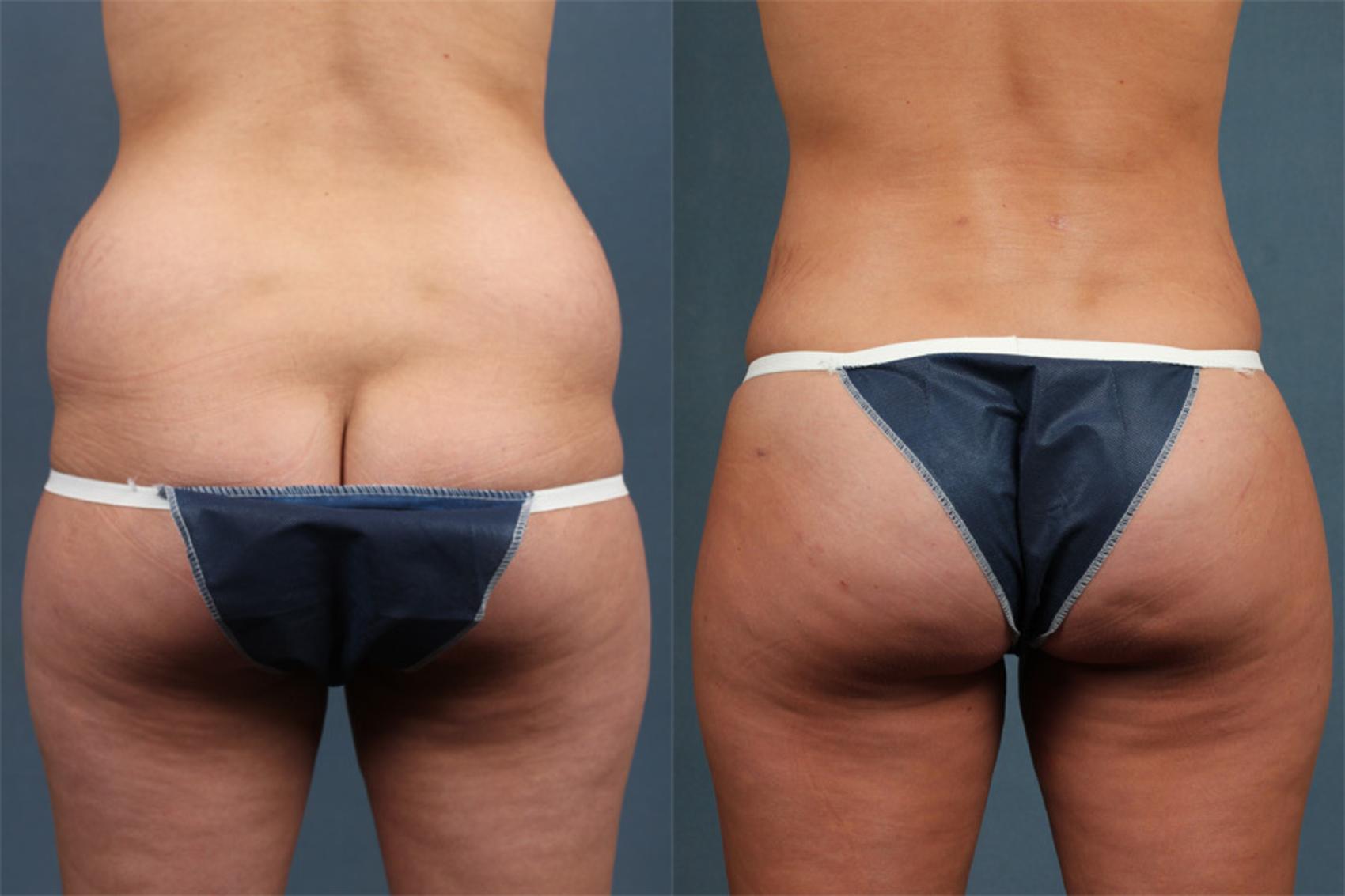 Before And After Brazilian Butt Lift Hohpatodays
