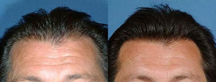 Before & After Hair Transplant Case 105 View #1 View in Louisville & Lexington, KY