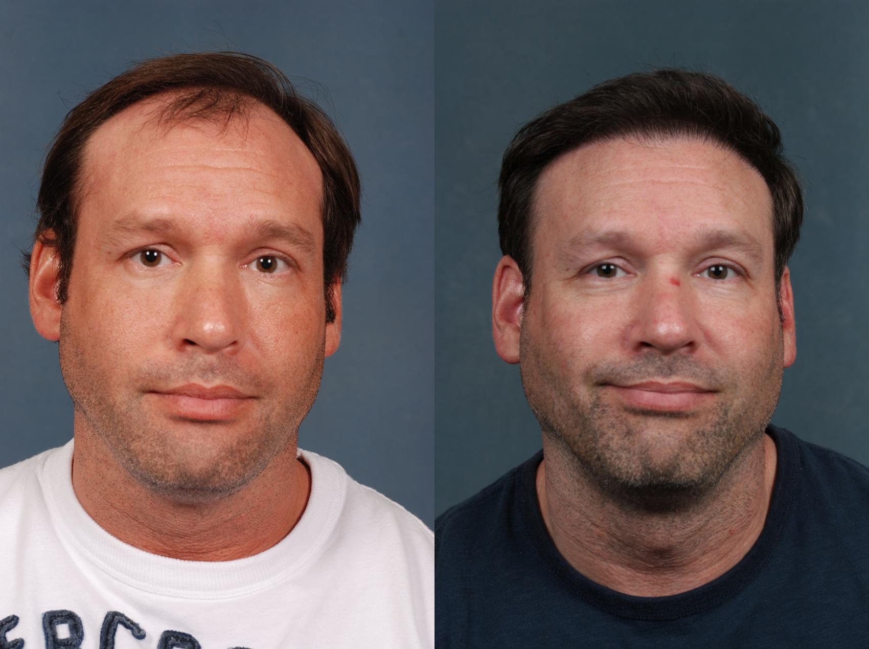 Before & After Hair Transplant Case 263 View #1 View in Louisville & Lexington, KY