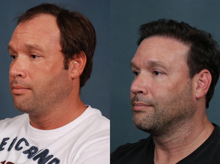 Before & After Hair Transplant Case 263 View #2 View in Louisville & Lexington, KY
