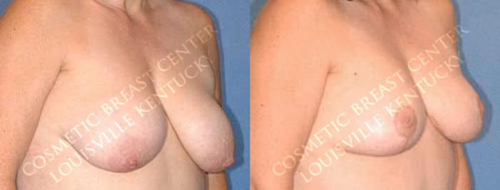 Before & After Lift Case 41 View #2 View in Louisville & Lexington, KY
