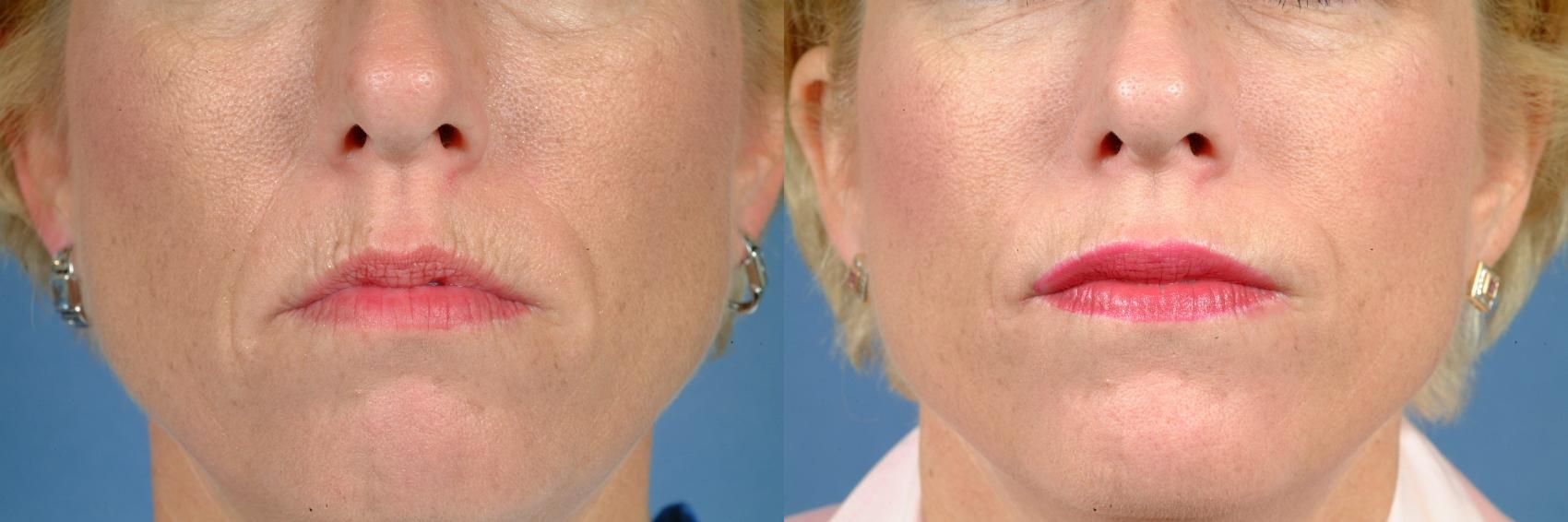 Lip Injections Case 626 Before & After Front | Louisville, KY | CaloSpa® Rejuvenation Center
