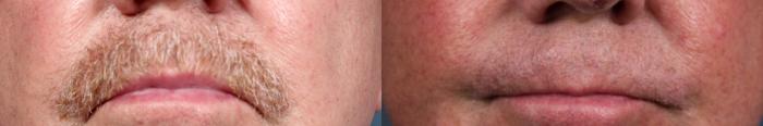 Before & After Lip Lift Case 715 Front View in Louisville & Lexington, KY
