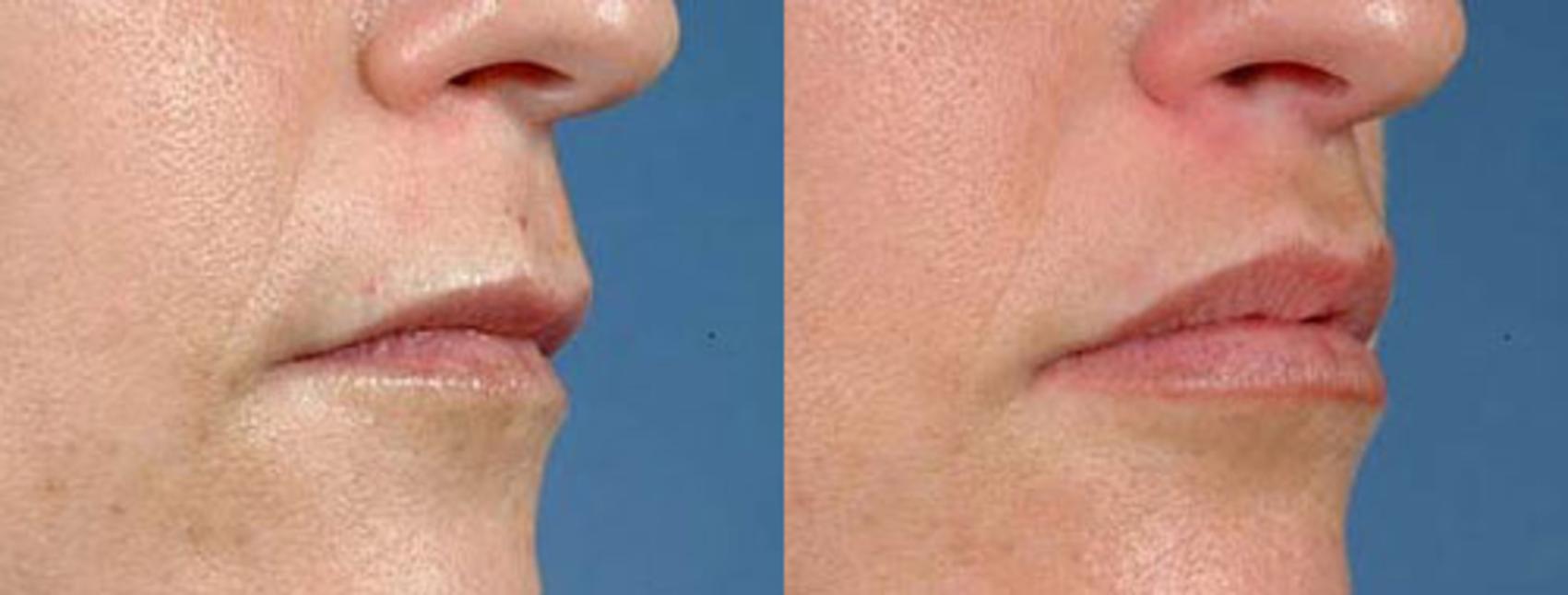 Before & After Lip Lift Case 90 View #1 View in Louisville & Lexington, KY