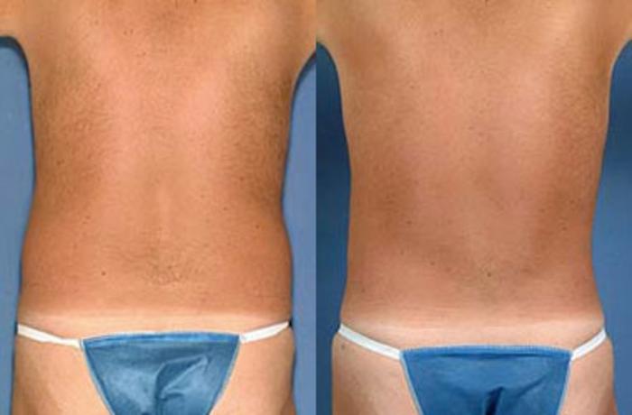Before & After Liposuction for Men Case 115 View #2 View in Louisville & Lexington, KY