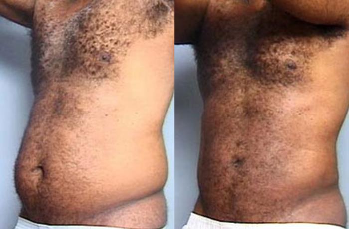 Before & After Liposuction for Men Case 117 View #2 View in Louisville & Lexington, KY