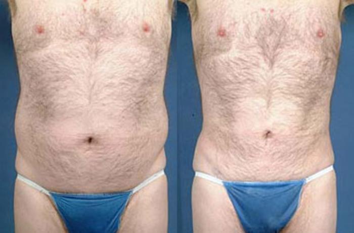 Before & After Liposuction for Men Case 119 View #1 View in Louisville & Lexington, KY
