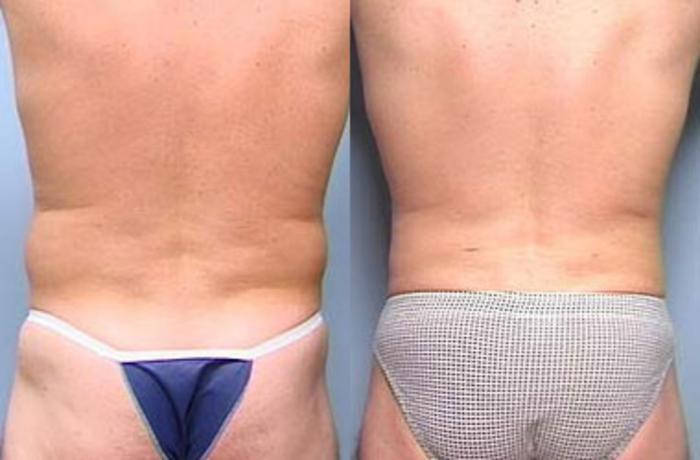 Before & After Liposuction for Men Case 121 View #2 View in Louisville & Lexington, KY