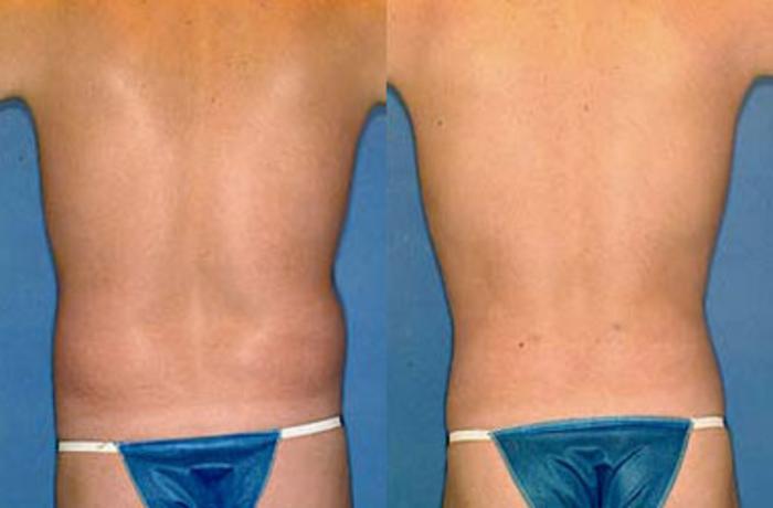 Before & After Liposuction for Men Case 123 View #2 View in Louisville & Lexington, KY