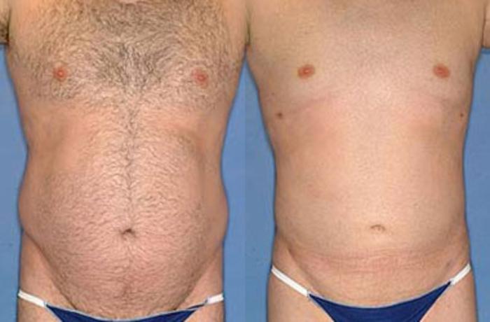 Before & After Liposuction for Men Case 134 View #2 View in Louisville & Lexington, KY