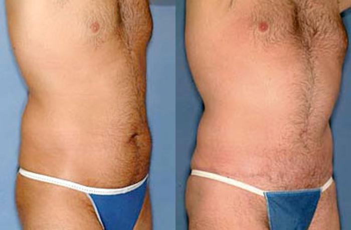 Before & After Liposuction for Men Case 149 View #2 View in Louisville & Lexington, KY