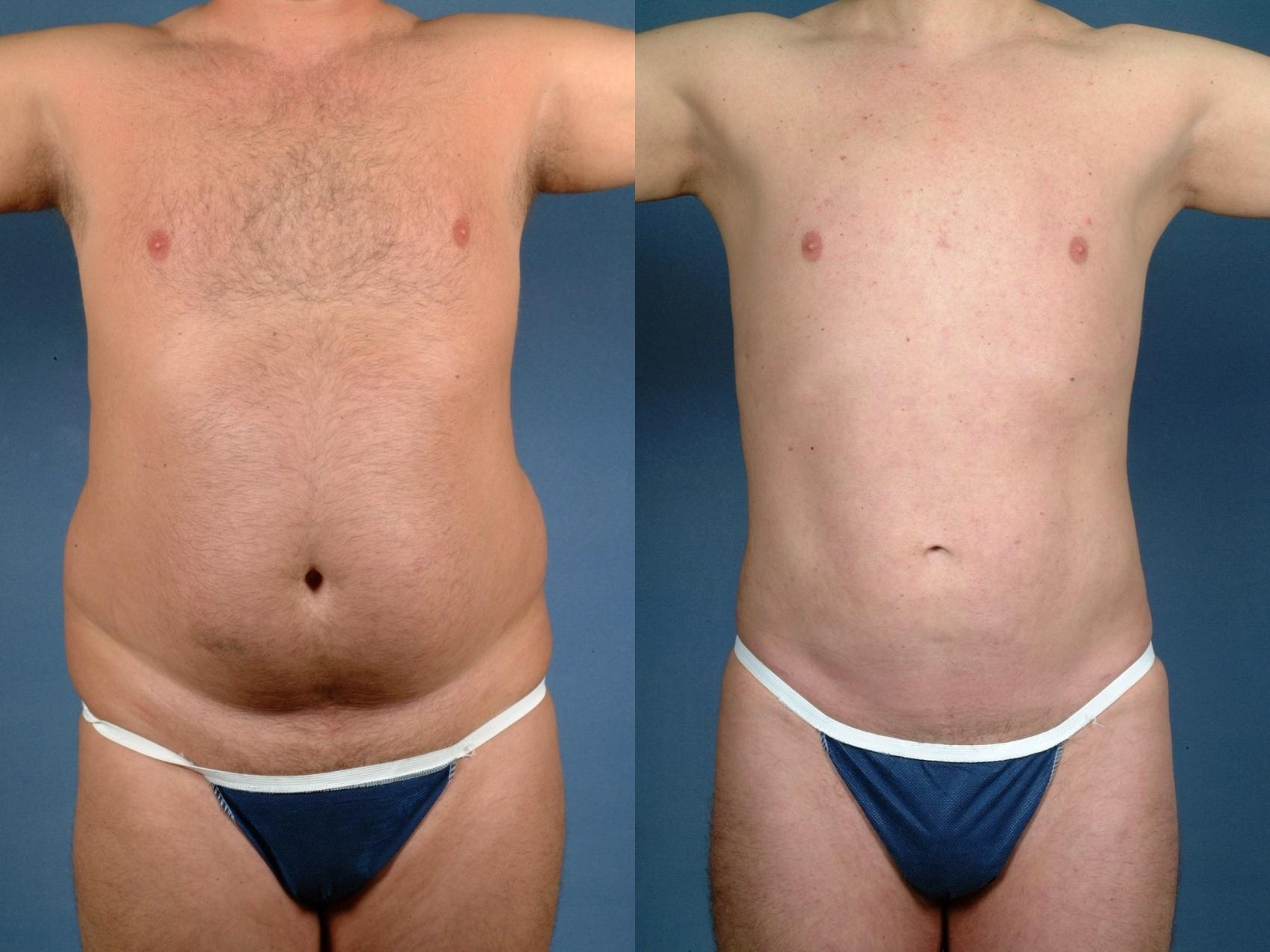 Before & After Liposuction for Men Case 722 Front View in Louisville & Lexington, KY