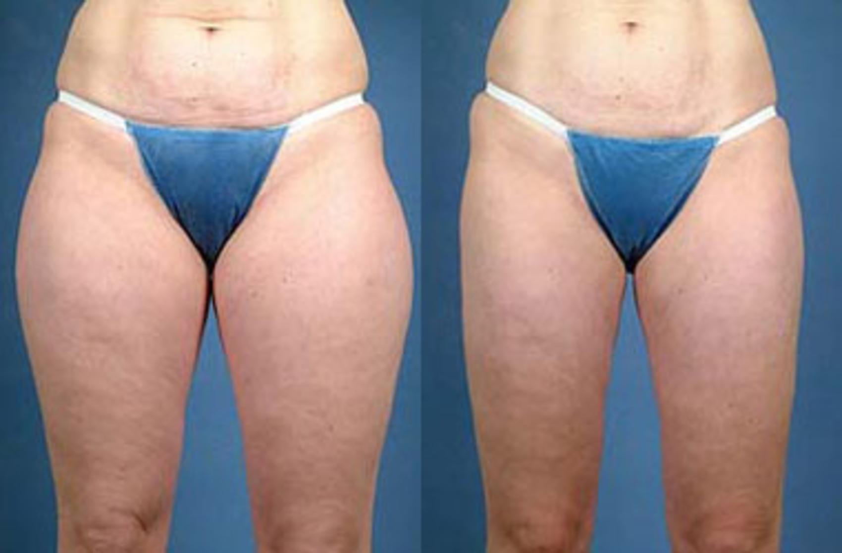 Before & After Liposuction for Women Case 120 View #1 View in Louisville & Lexington, KY