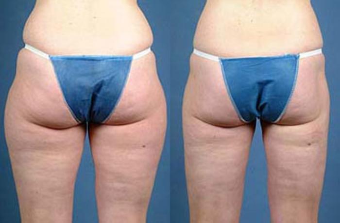 Before & After Liposuction for Women Case 120 View #2 View in Louisville & Lexington, KY