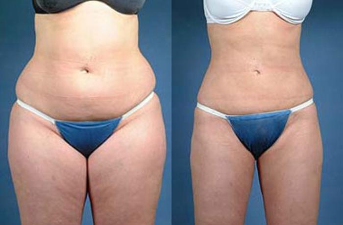 Before & After Liposuction for Women Case 122 View #1 View in Louisville & Lexington, KY