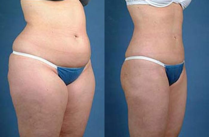 Before & After Liposuction for Women Case 122 View #2 View in Louisville & Lexington, KY