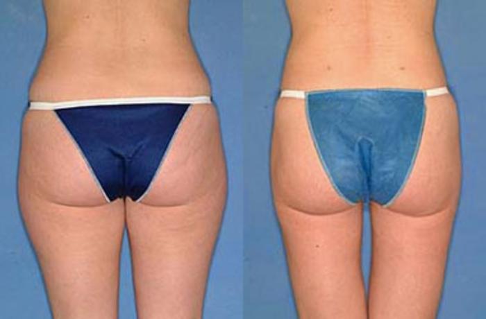 Before & After Liposuction for Women Case 124 View #2 View in Louisville & Lexington, KY