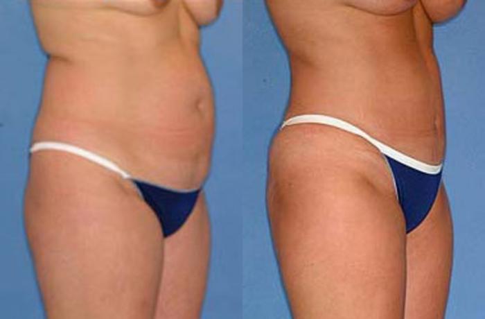 Before & After Liposuction for Women Case 125 View #1 View in Louisville & Lexington, KY