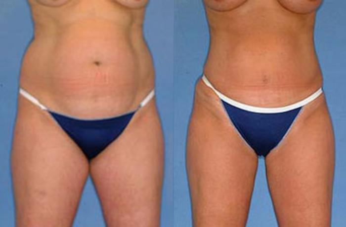 Before & After Liposuction for Women Case 125 View #2 View in Louisville & Lexington, KY