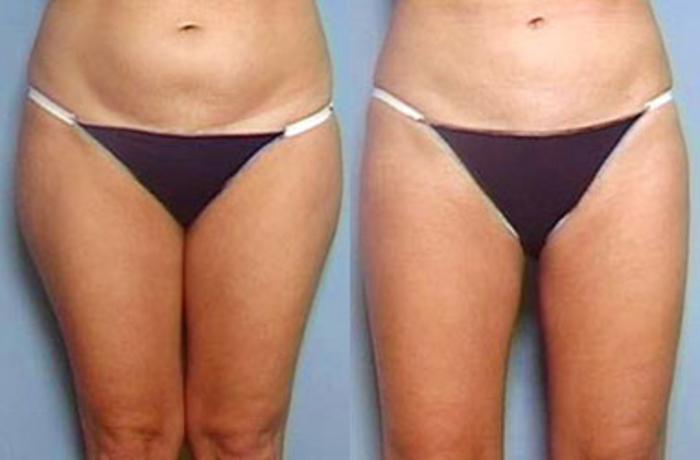 Before & After Liposuction for Women Case 132 View #1 View in Louisville & Lexington, KY
