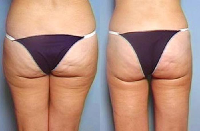 Before & After Liposuction for Women Case 132 View #2 View in Louisville & Lexington, KY