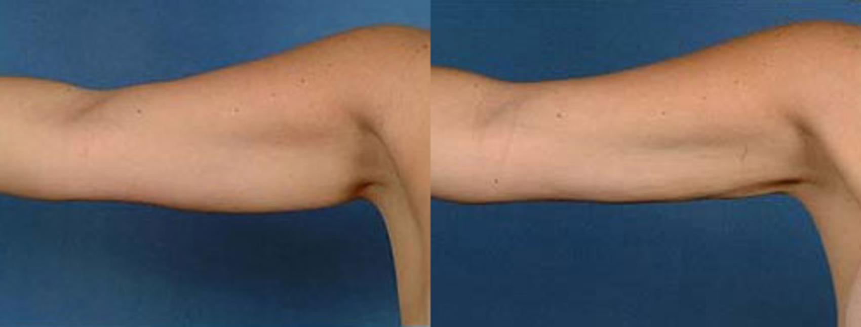 Before & After Liposuction for Women Case 135 View #1 View in Louisville & Lexington, KY