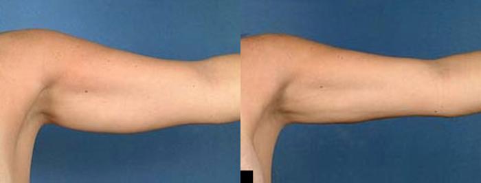 Before & After Liposuction for Women Case 135 View #2 View in Louisville & Lexington, KY