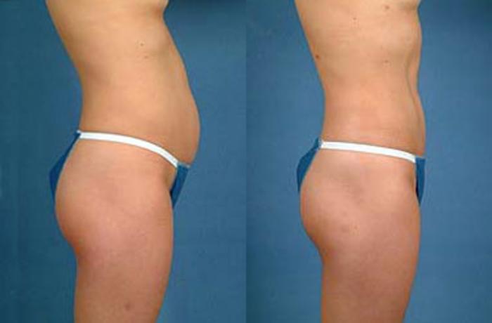Before & After Liposuction for Women Case 145 View #2 View in Louisville & Lexington, KY