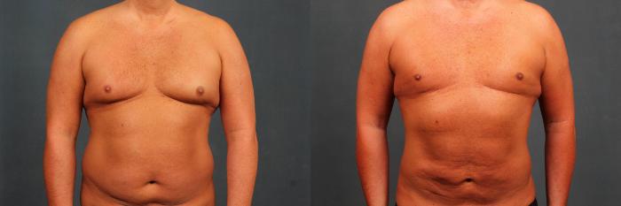 Before & After Male Reduction Case 718 Front View in Louisville & Lexington, KY