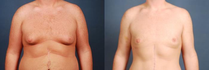 Before & After Male Reduction Case 724 Front View in Louisville & Lexington, KY