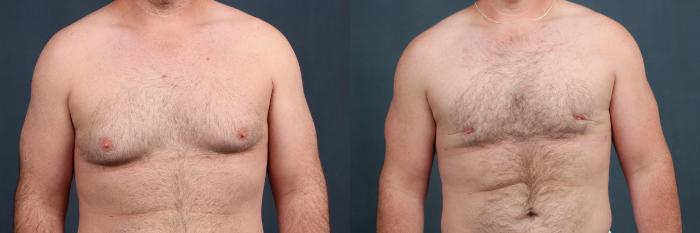Before & After Male Reduction Case 727 Front View in Louisville & Lexington, KY