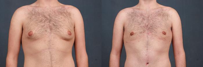 Before & After Male Reduction Case 729 Front View in Louisville & Lexington, KY