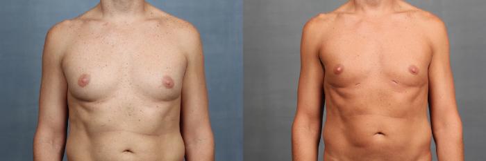 Before & After Male Reduction Case 732 Front View in Louisville & Lexington, KY