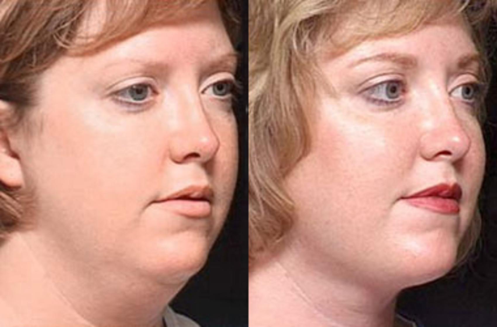 Before & After Neck Procedures Case 109 View #1 View in Louisville & Lexington, KY