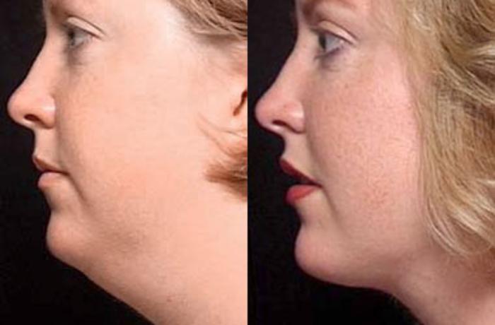 Before & After Neck Procedures Case 109 View #2 View in Louisville & Lexington, KY