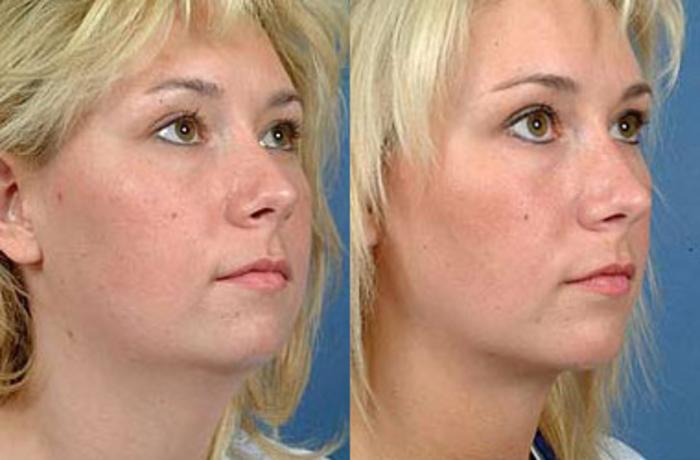 Before & After Neck Procedures Case 110 View #1 View in Louisville & Lexington, KY