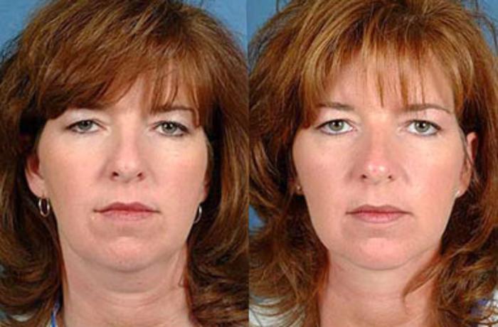Before & After Neck Procedures Case 113 View #2 View in Louisville & Lexington, KY