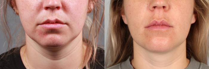 Neck Procedure, Liposuction with ThermiTight Before and After Photo