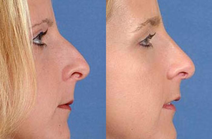 Before & After Nose Reshaping Case 100 View #2 View in Louisville & Lexington, KY