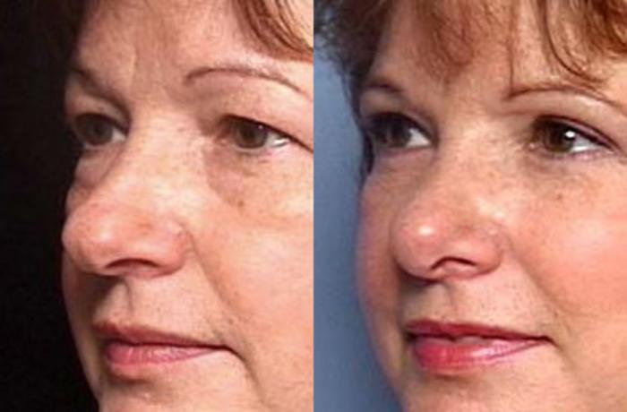 Before & After Nose Reshaping Case 101 View #2 View in Louisville & Lexington, KY