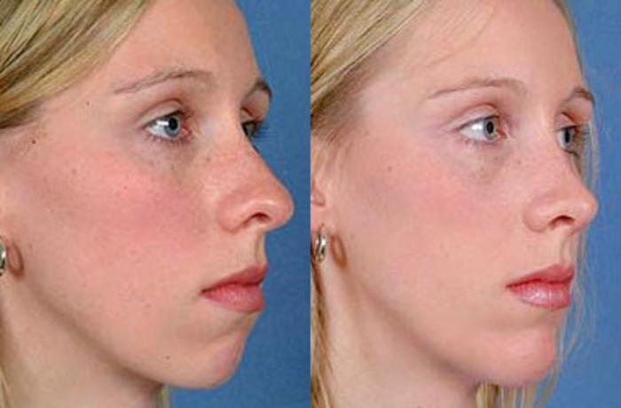 Before & After Nose Reshaping Case 102 View #2 View in Louisville & Lexington, KY