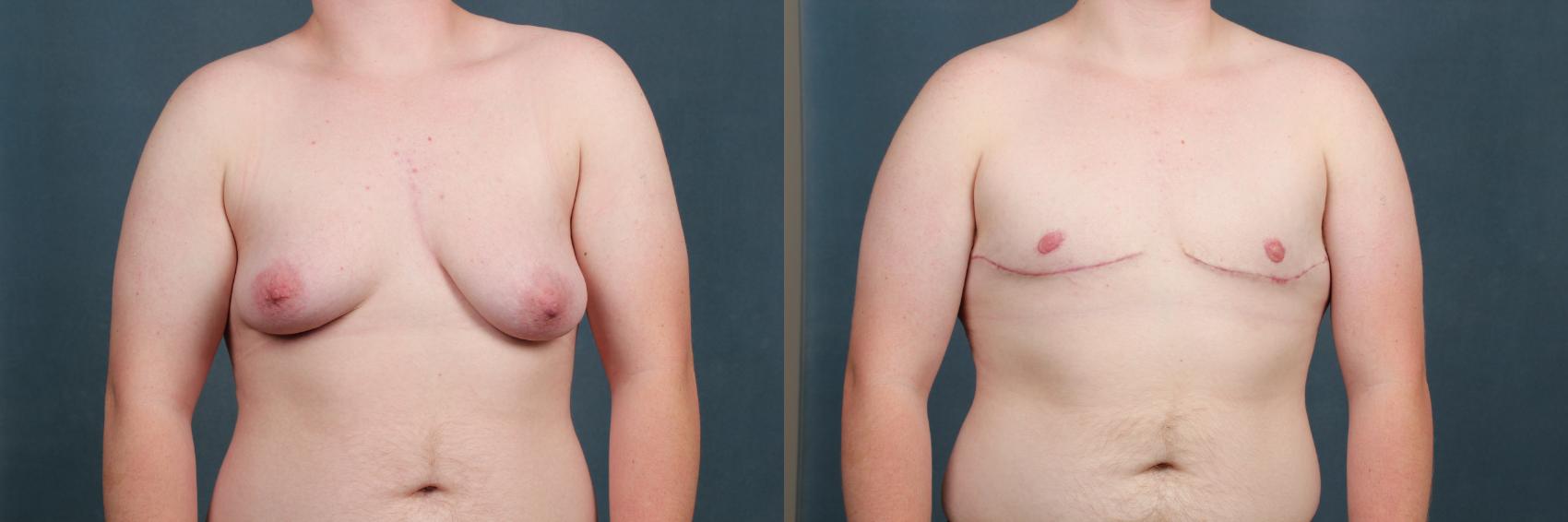 Before & After Top Surgery Case 733 Front View in Louisville & Lexington, KY
