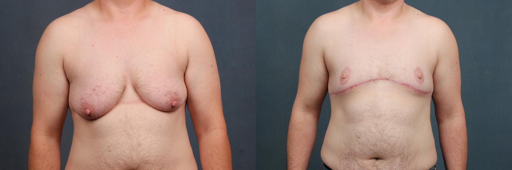 Top Surgery Case 736 Before & After Front | Louisville & Lexington, KY | CaloAesthetics® Plastic Surgery Center