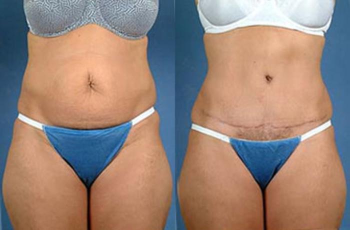 Before & After Tummy Tuck Case 141 View #1 View in Louisville & Lexington, KY