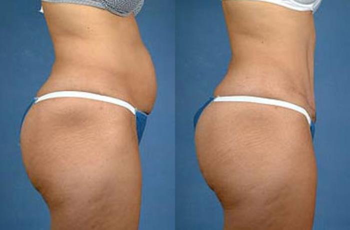 Before & After Tummy Tuck Case 141 View #2 View in Louisville & Lexington, KY