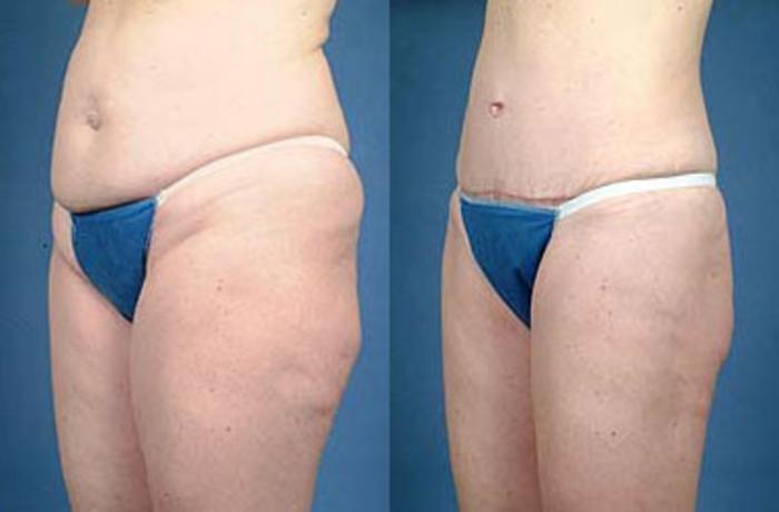 Before & After Tummy Tuck Case 148 View #2 View in Louisville & Lexington, KY