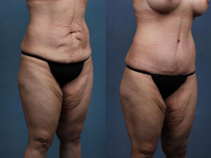 Before & After Tummy Tuck Case 565 View #2 View in Louisville & Lexington, KY