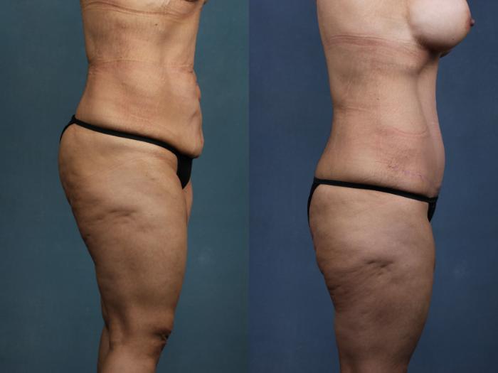 Before & After Tummy Tuck Case 565 View #3 View in Louisville & Lexington, KY