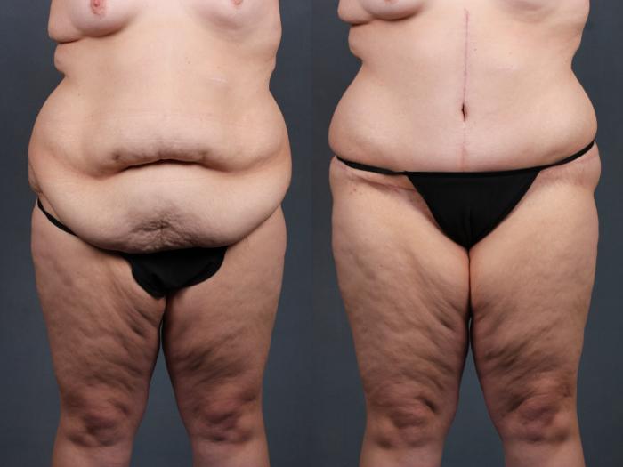 Before & After Tummy Tuck Case 566 View #1 View in Louisville & Lexington, KY